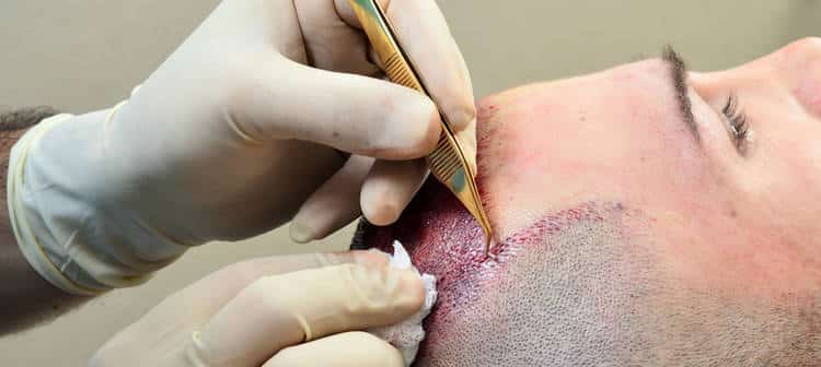 Trasplante Cabello